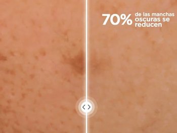 Vitamina C y manchas