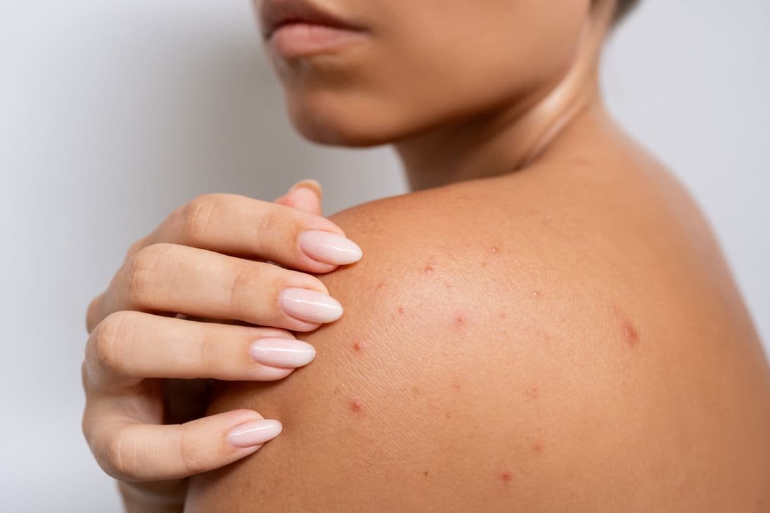 granitos por sudoracion