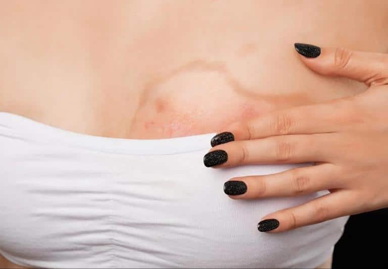 proteccion solar cicatrices