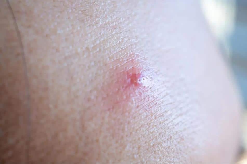 grano enquistado cara