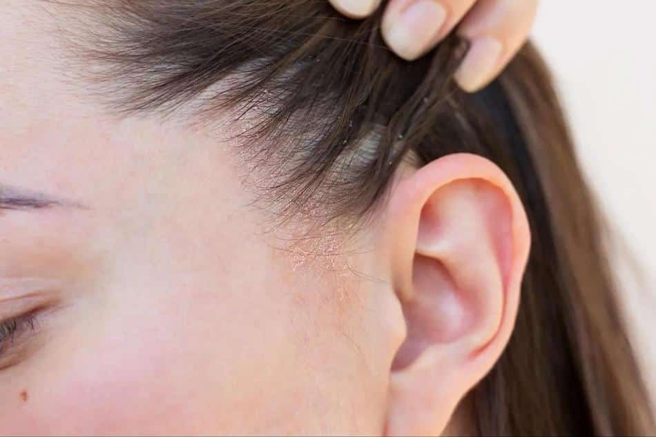 por que sale caspa en el pelo y como se quita