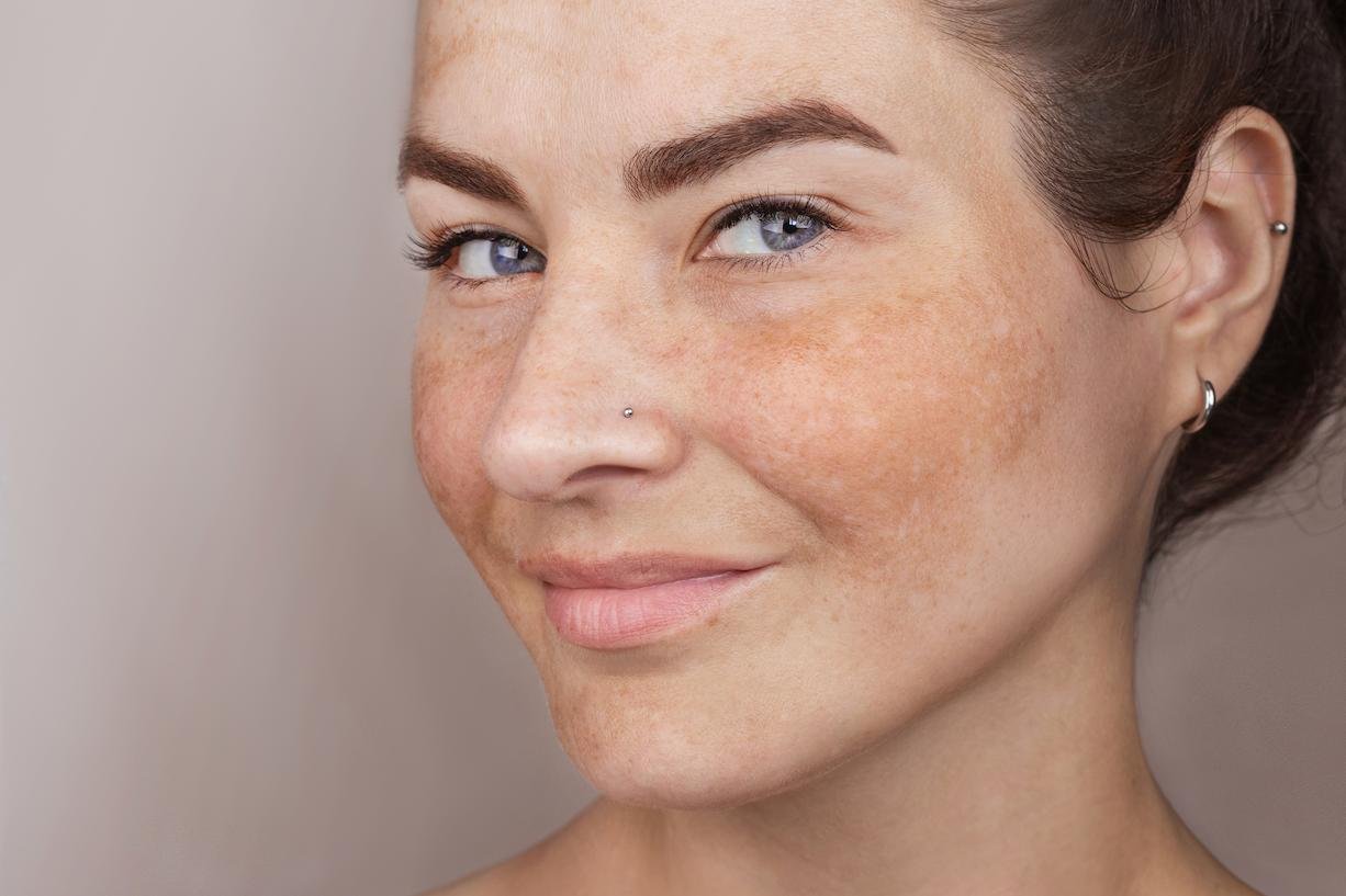 manchas de pigmentacion