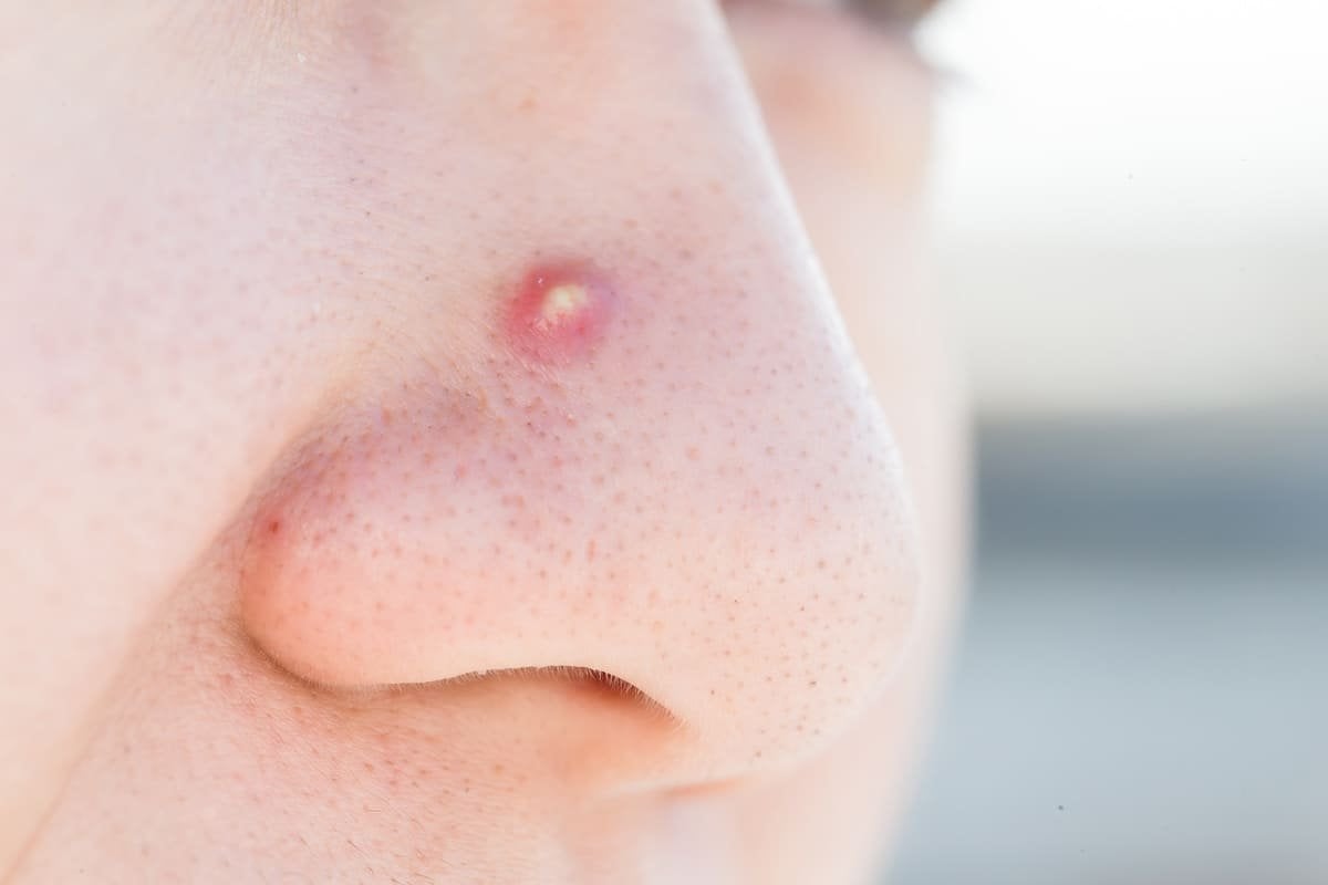 granito dentro de la nariz